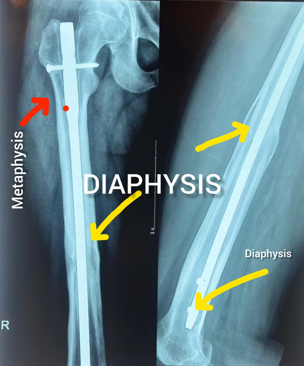 Understanding Bone Structure: Why Some Bones Break Differently and Heal Better Than Others