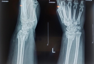 Distal radius fractures x-ray