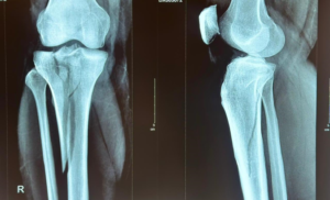 tibia-plateau-frecture-xray