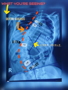 Recognizing the Warning Signs of Scoliosis