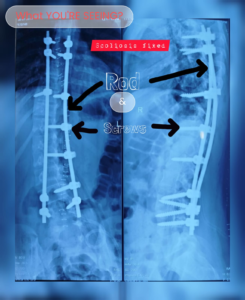 x-ray-Case-from-Our-Spine-Surgery