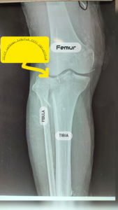 Tibial Spine Injury