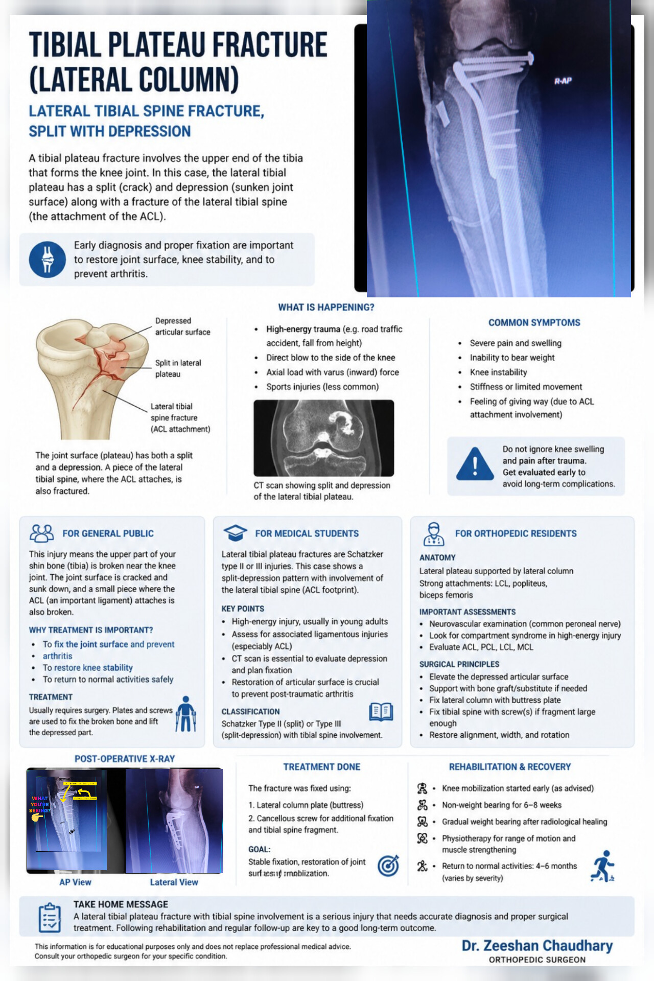 A Split Depression Fracture of the Lateral Tibial Plateau with Tibial Spine Injury