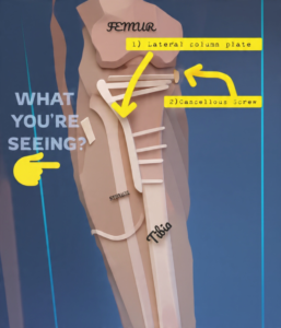 tibia-literal-column-plate