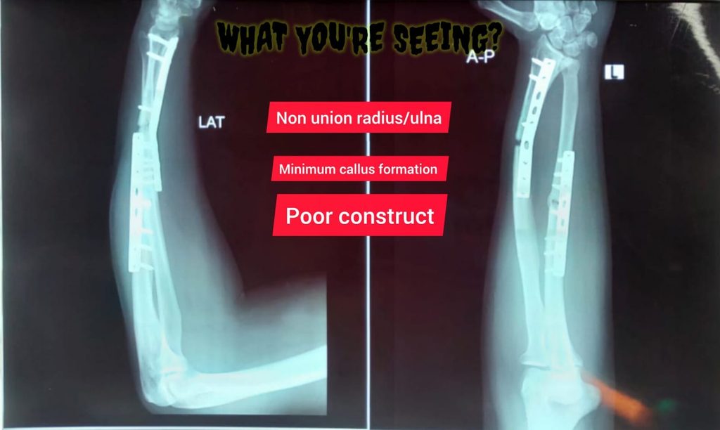 Nonunion poor costruct case diary