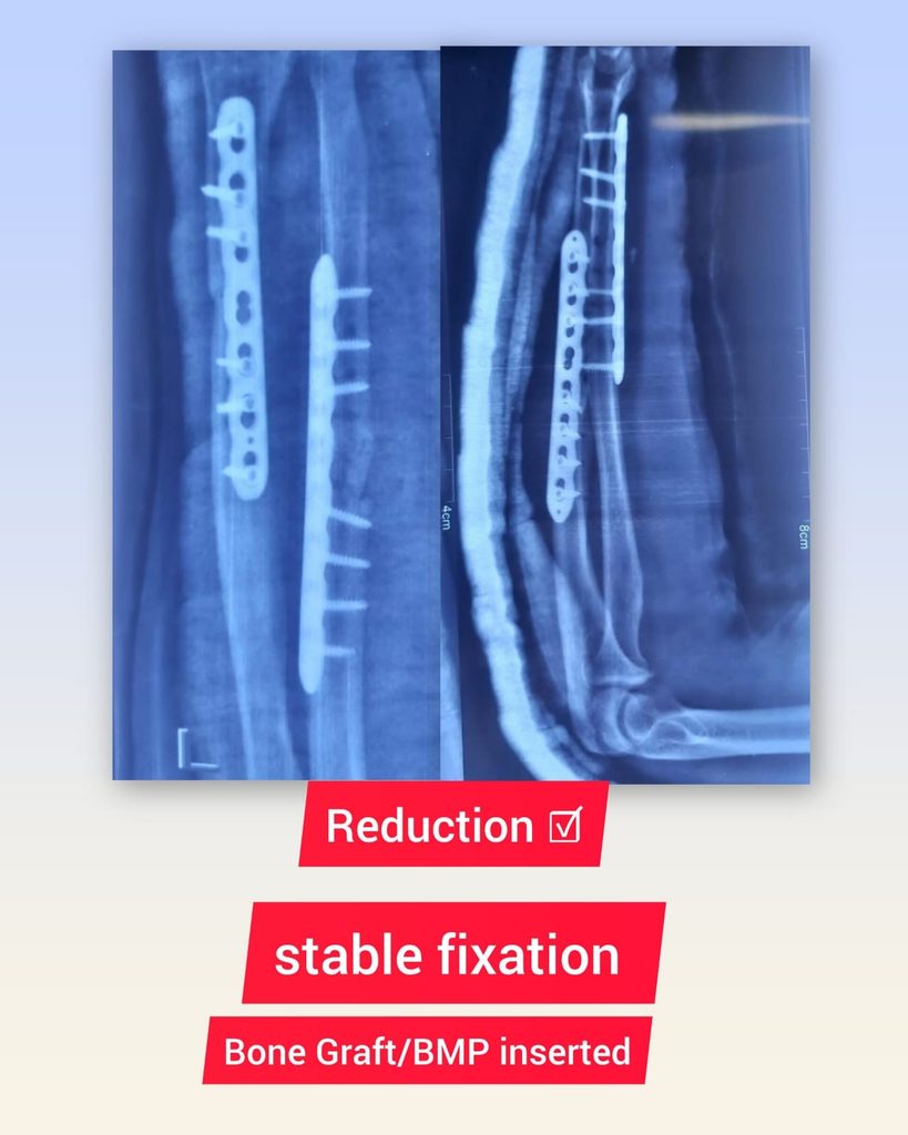 stable-fixation-bone-graft/bmp-inserted