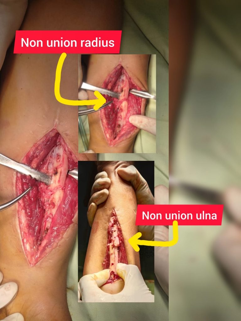 non-union-ulna-inner-surgical-diary