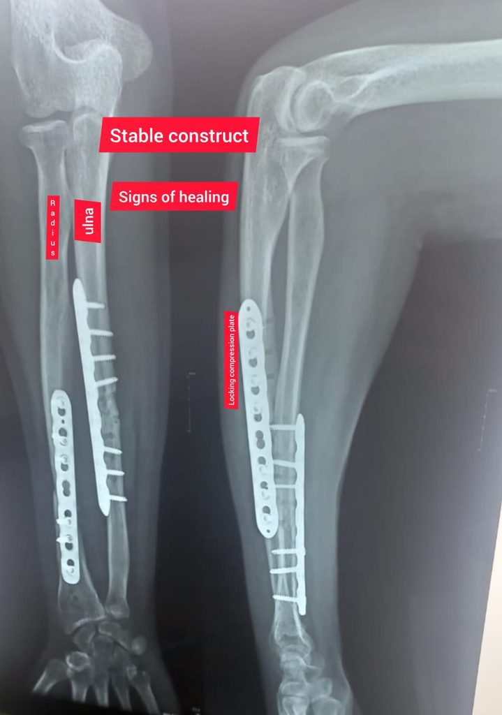 signs-of-healing-after-stable-consturct